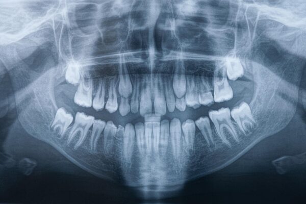 Radiografia panoramică dentară: ce este și când este recomandată